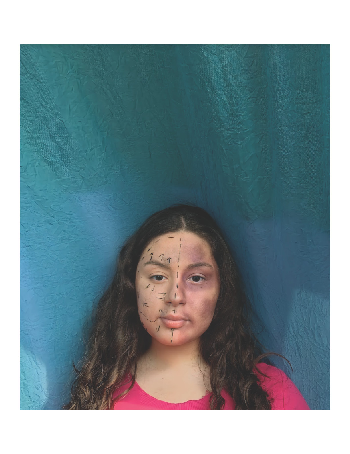 Photograph of a girl wit lines on one side of her face and bruises on the other